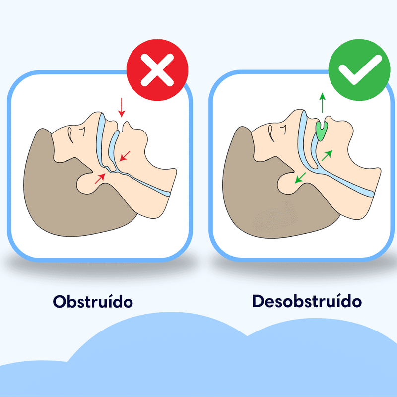Molde Dental SilentPro Anti Ronco – SilentSleep™ - [Durma com Qualidade]